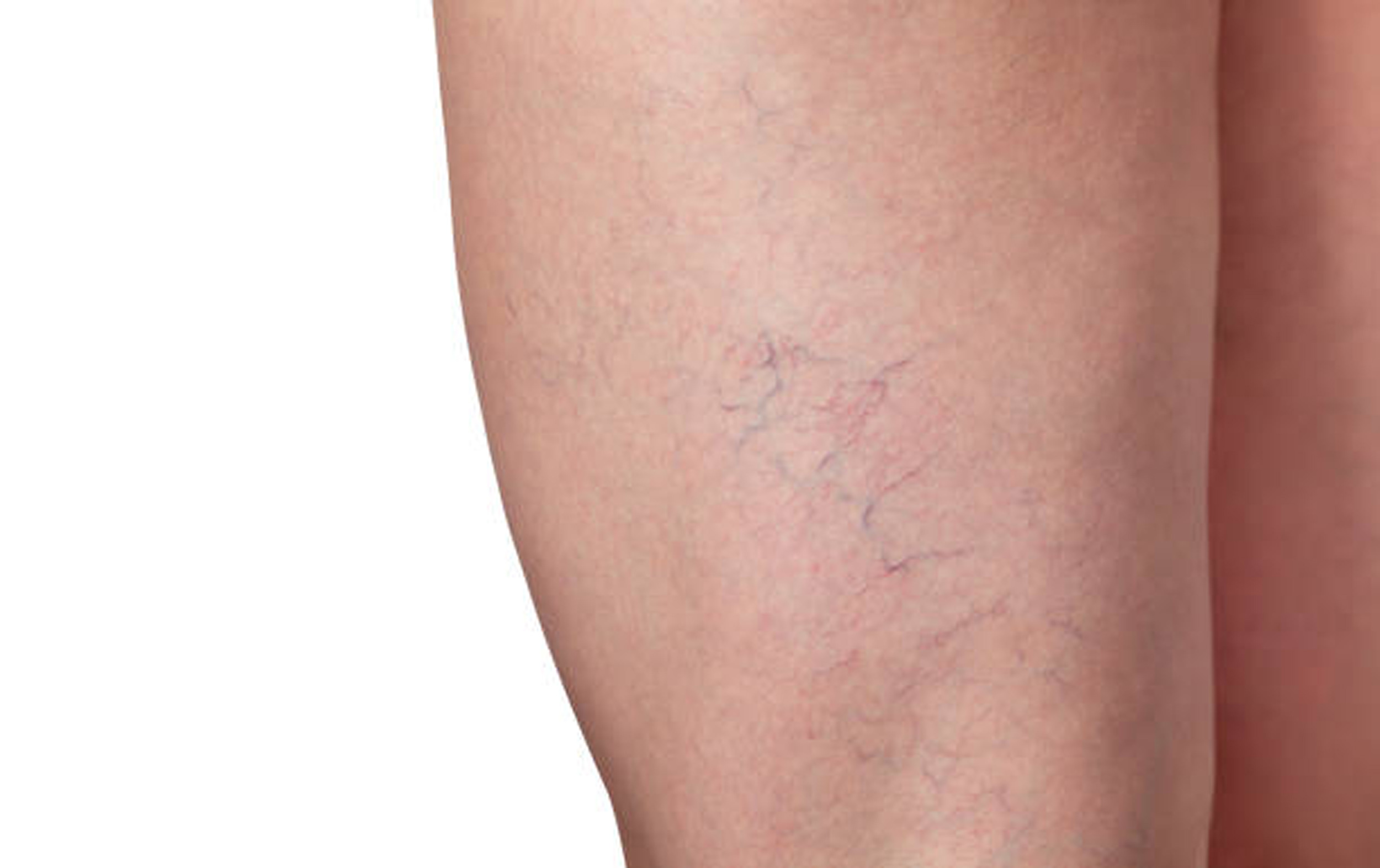 Spider Veins Spider Vein Removal Treatments in Sydney