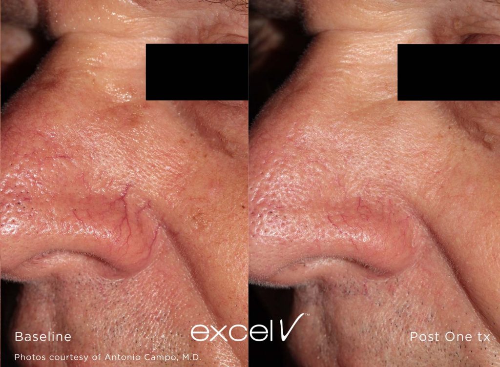excel v facial laser treatment