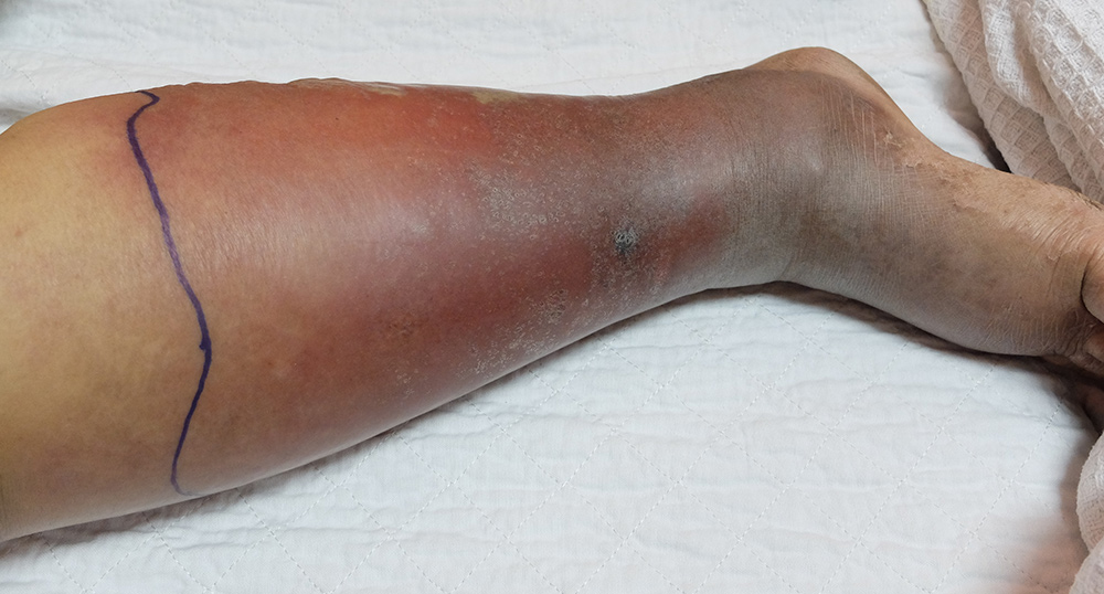 does smoking cause varicose veins