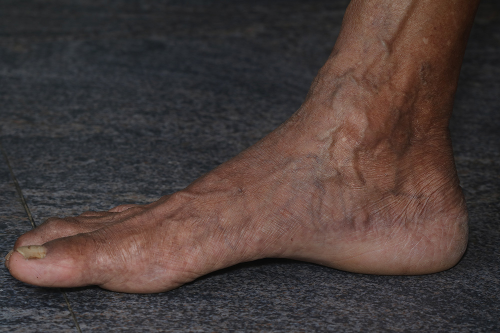 Varicose veins in feet and ankles