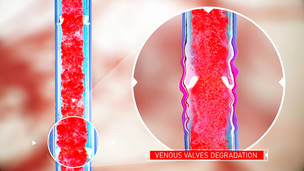 Understanding Varicose Veins in Feet and Ankles
