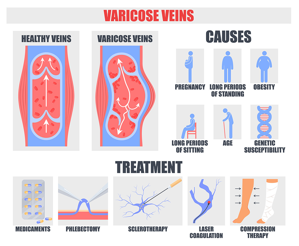How Do Varicose Veins Form | What Do Varicose Veins Feel Like | Early Signs of Varicose Veins