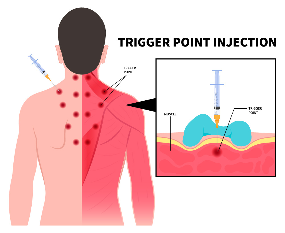 Spinal Injection for Back Pain | Which Injection is Best for Back Pain | Facet Joint Injections