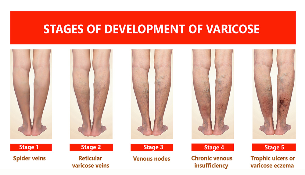 varicose veins stages blood flow skin health overall vein function