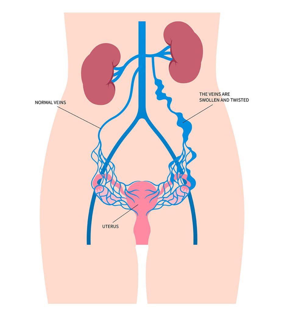 Pelvic Congestion Syndrome Symptoms | What is Pelvic Congestion Syndrome | What Causes Pelvic Congestion Syndrome