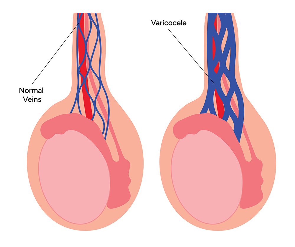 Varicocele Symptoms | Varicocele Causes | What is Varicocele