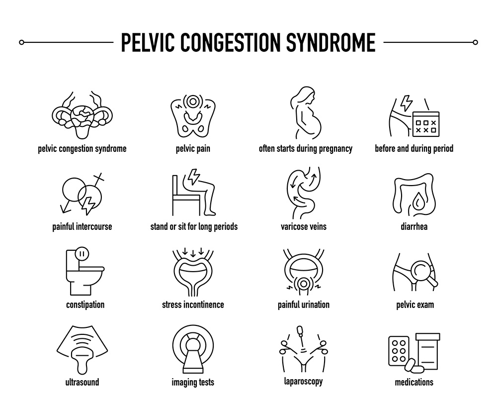 Pelvic Congestion Syndrome Symptoms | What is Pelvic Congestion Syndrome | What Causes Pelvic Congestion Syndrome