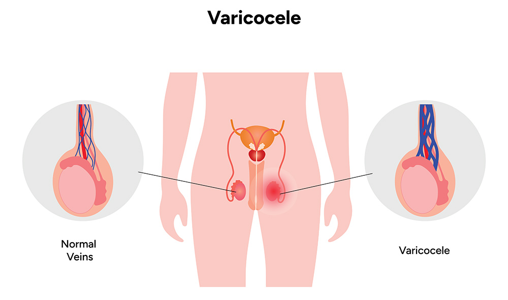 Varicocele Symptoms | Varicocele Causes | What is Varicocele