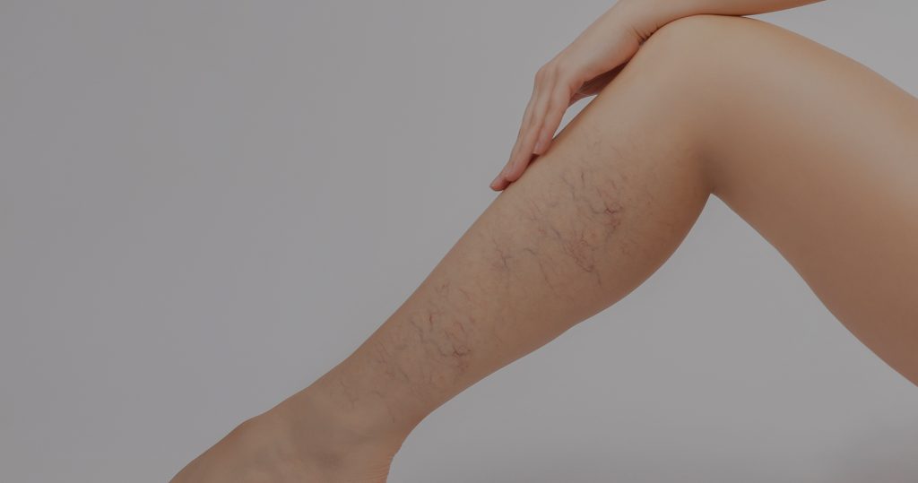 Sclerotherapy vs Laser for Spider Veins | Laser Therapy for Spider Veins | Sclerotherapy for Spider Veins