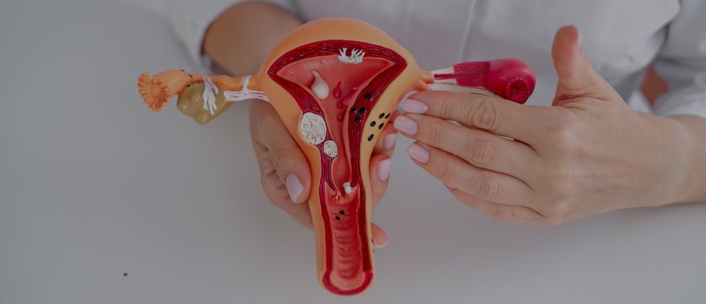 Uterine Fibroid Symptoms | What Are Uterine Fibroids | Fibroids Symptoms